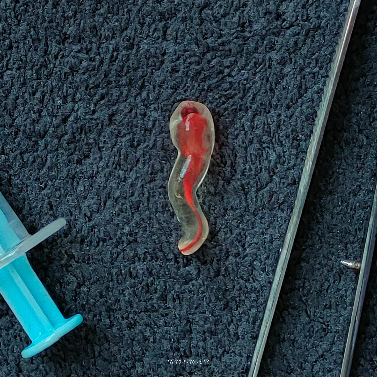 S-Shaped Canal Premolar — image 1 of 3
