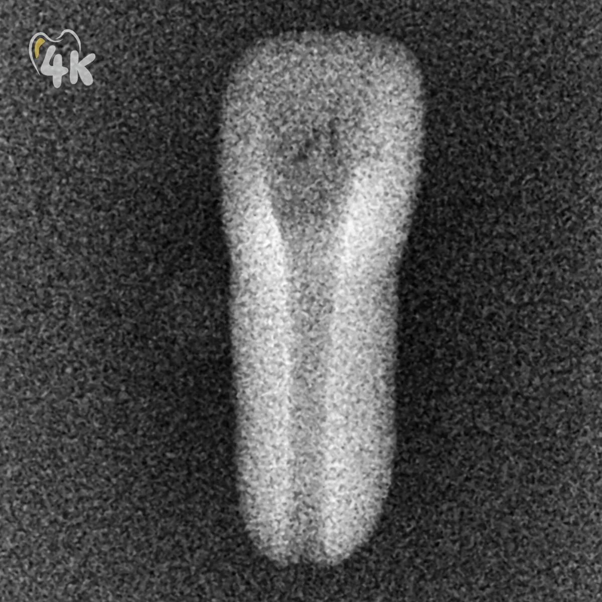Internal Resorption — L4 Premolar — 4K-IRS-L4